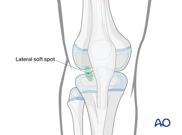 Lateral soft spot