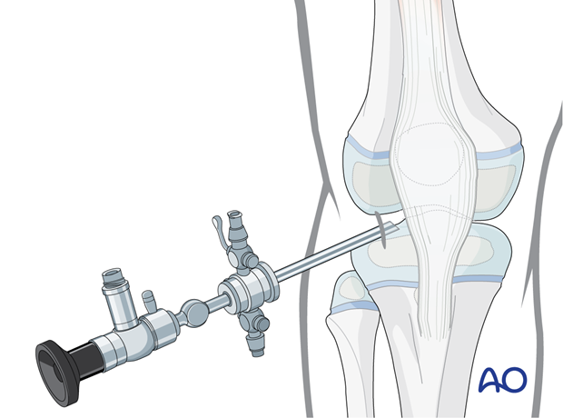 Insertion of the arthroscope