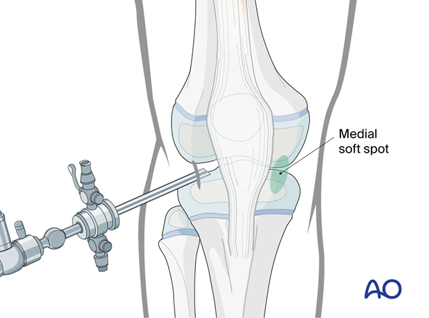 Medial soft spot