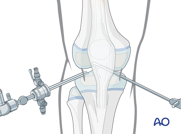 Standard arthroscopic approach to the knee with anteromedial and anterolateral portals