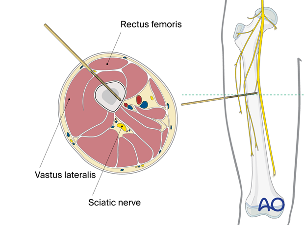 Anterolateral approach