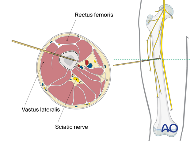 Direct lateral approach