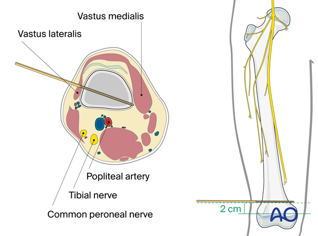 Safe zone for pin insertion in the distal third