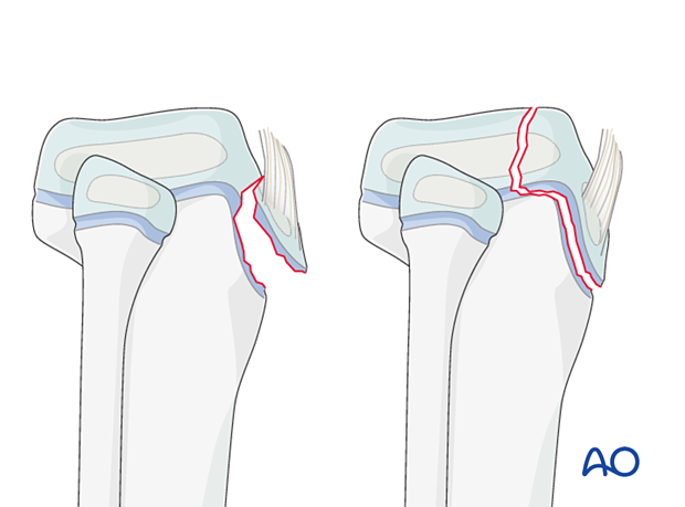 Avulsion of the tibial apophysis (41t-M/7) is caused by the patellar tendon, occurs in adolescents nearing skeletal maturity, and may cause growth disturbance in younger patients.