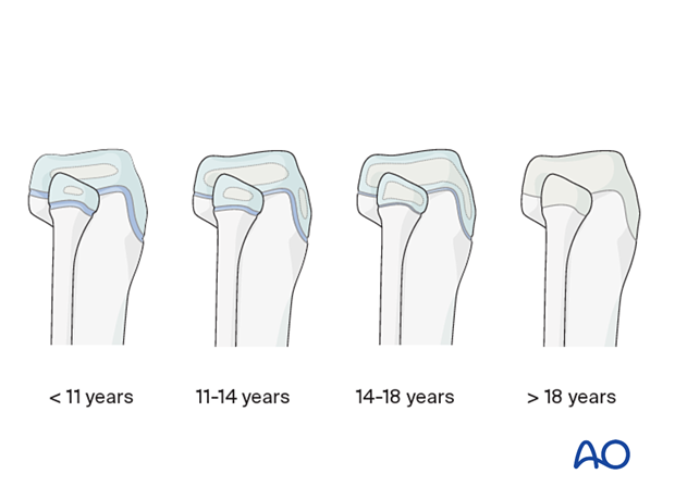 The tibial tubercle is cartilaginous in young children, develops into an apophysis between 11-14 years, and fuses by 14-18 years. Avulsion typically occurs in adolescents around physeal closure, with displacement depending on injury.