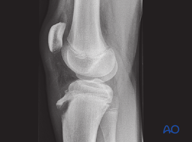 Extraarticular apophyseal avulsion fracture