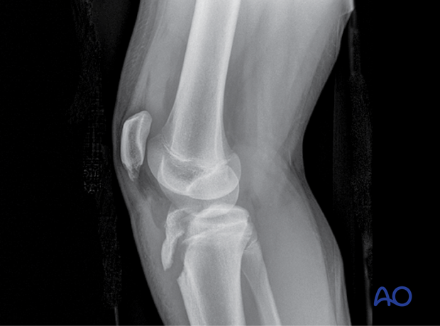 Intraarticular apophyseal avulsion fracture