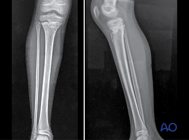 AP and lateral x-rays of a pediatric proximal tibial fracture