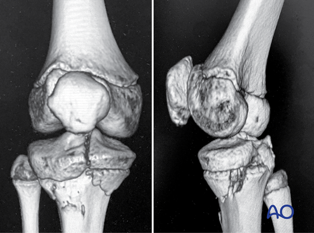 CT images showing a case of a Salter-Harris IV fracture of the proximal tibia