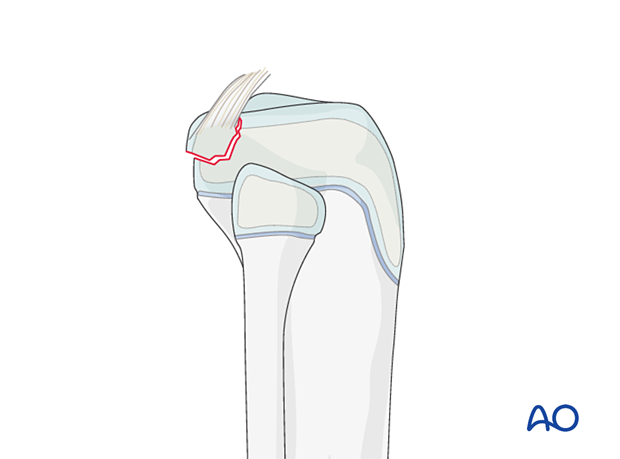 PCL avulsion knee dislocation; may involve ACL and collateral ligaments; uncommon in children.