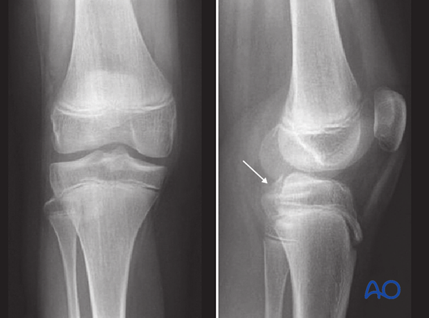 X-rays show PCL avulsion in 16-year-old.