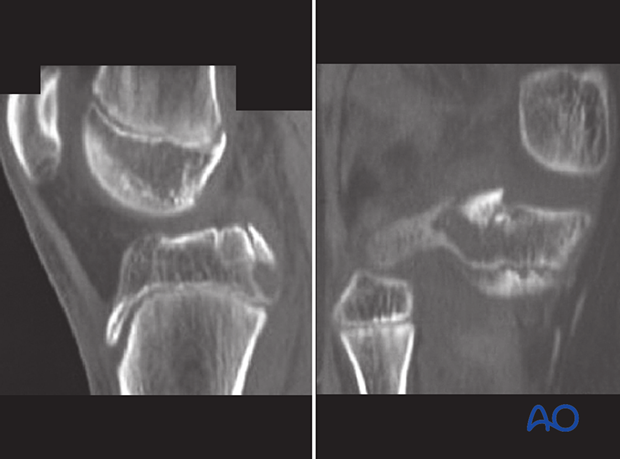 CT scan may needed for precise fracture pattern assessment.