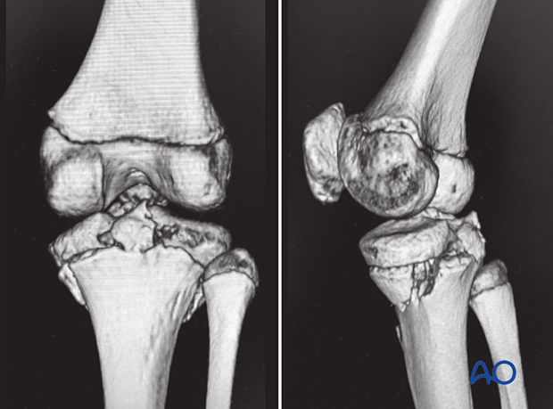 3D CT images Salter-Harris type-IV fracture posterior tibial spine avulsion.