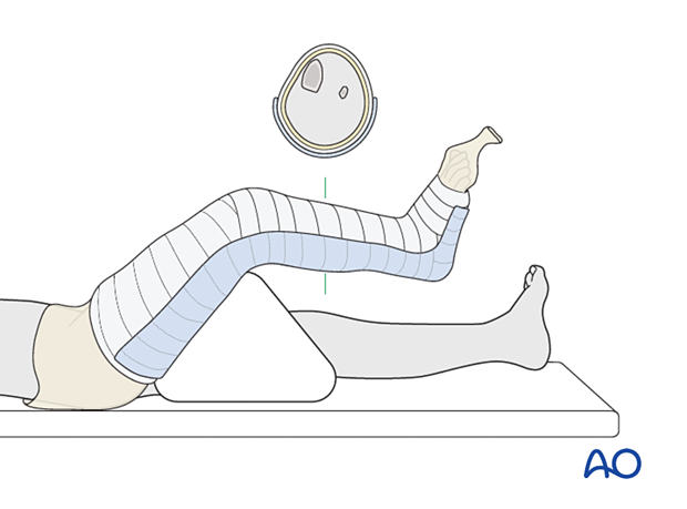 Application of the back slab for long leg splint