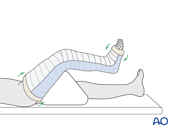 Folding bandage and padding over the distal edge of the long leg splint