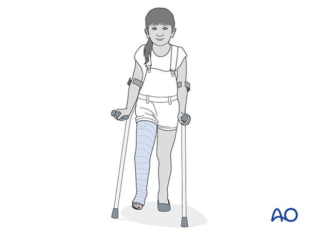 Pediatric patient with a long leg cast walking with crutches