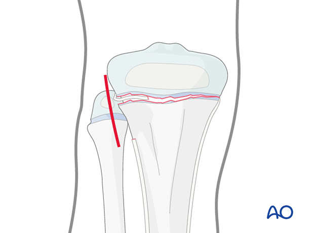 Incision for open reduction of entrapped periosteum in a Salter-Harris type-I fracture of the proximal tibia