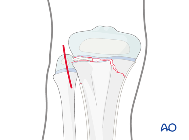 Incision for open reduction of entrapped periosteum in a Salter-Harris type-II fracture of the proximal tibia