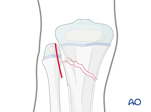 Incision for open reduction of entrapped periosteum in a metaphyseal fracture of the proximal tibia