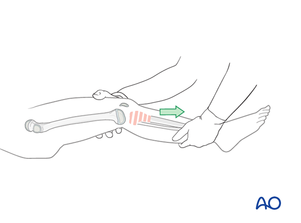 Gentle, prolonged longitudinal traction for indirect reduction of a proximal tibial fracture