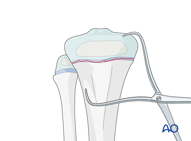 Direct reduction of a Salter-Harris type-I fracture of the proximal tibia