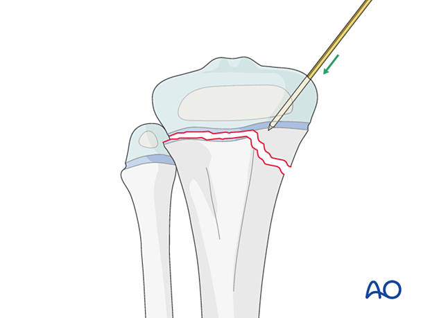 Reduction of a Salter-Harris type-II fracture of the proximal tibia with a K-wire