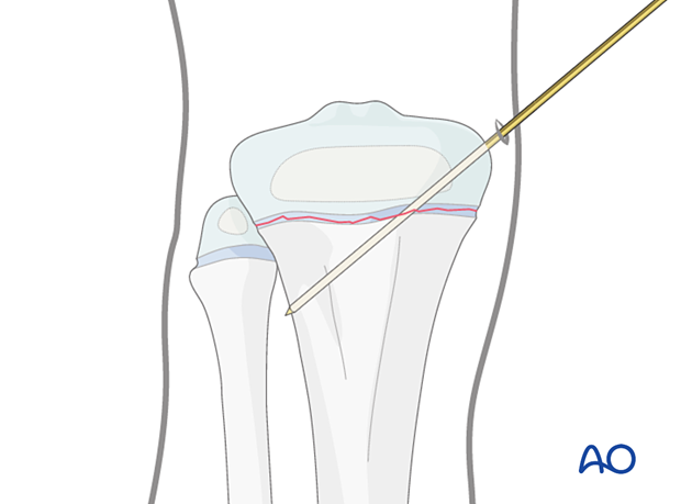 Insertion of first K-wire for fixation of a Salter-Harris type-I fracture of the proximal tibia