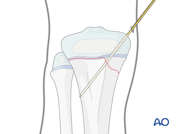 Incision for open reduction of entrapped periosteum in a Salter-Harris type-II fracture of the proximal tibia