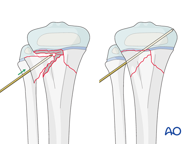 Reduction and fixation of a fragment of a multifragmentary Salter-Harris type-II fracture of the proximal tibia with a K-wire