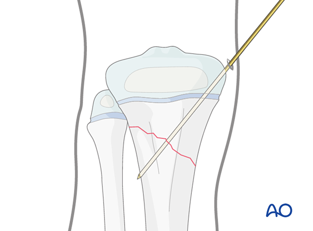 Insertion of first K-wire for fixation of a metaphyseal fracture of the proximal tibia