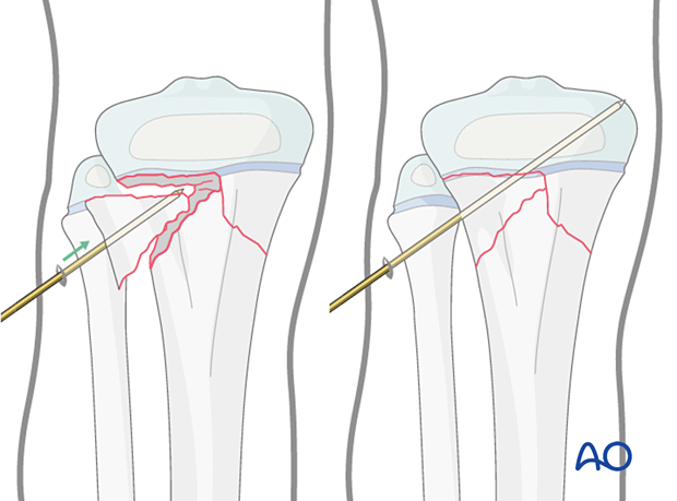 Reduction and fixation of a fragment of a multifragmentary Salter-Harris type-II fracture of the proximal tibia with a K-wire