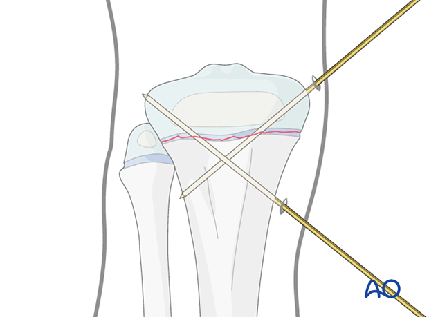 Insertion of second K-wire for fixation of a Salter-Harris type-I fracture of the proximal tibia