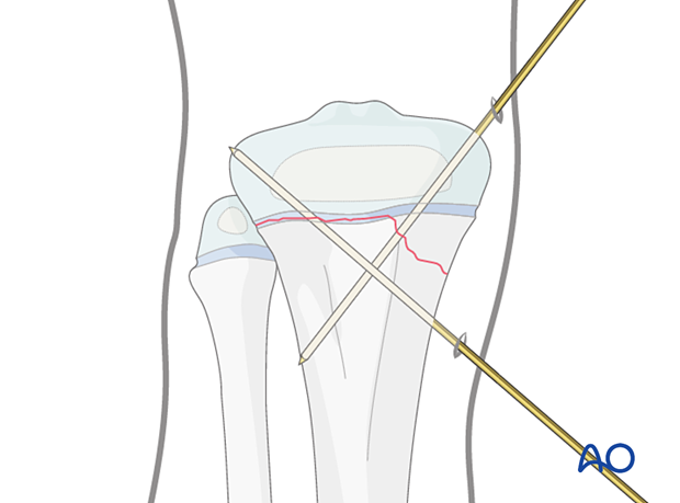 Insertion of second K-wire for fixation of a Salter-Harris type-II fracture of the proximal tibia