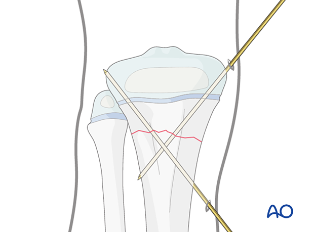 Insertion of second K-wire for fixation of a metaphyseal fracture of the proximal tibia