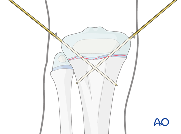 Insertion of second K-wire for fixation of a Salter-Harris type-I fracture of the proximal tibia