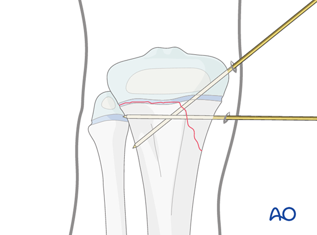 Insertion of second K-wire for fixation of a Salter-Harris type-II fracture of the proximal tibia