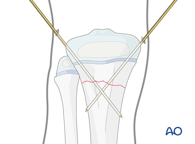 Insertion of second K-wire for fixation of a metaphyseal fracture of the proximal tibia