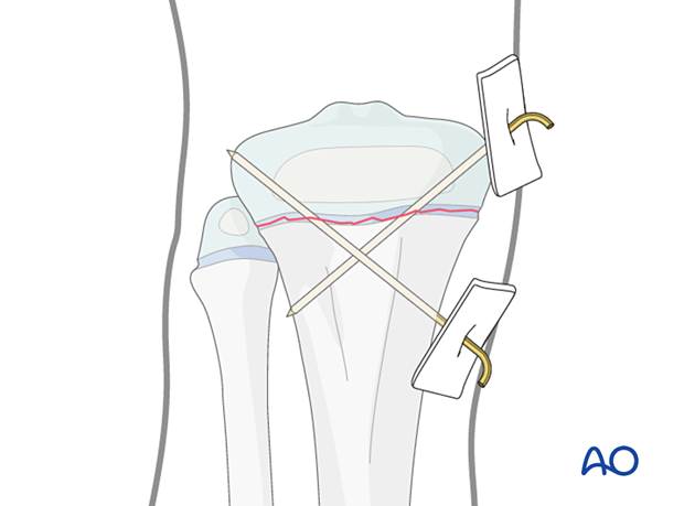 K-wire-wire fixation of a Salter-Harris type-I fracture of the proximal tibia