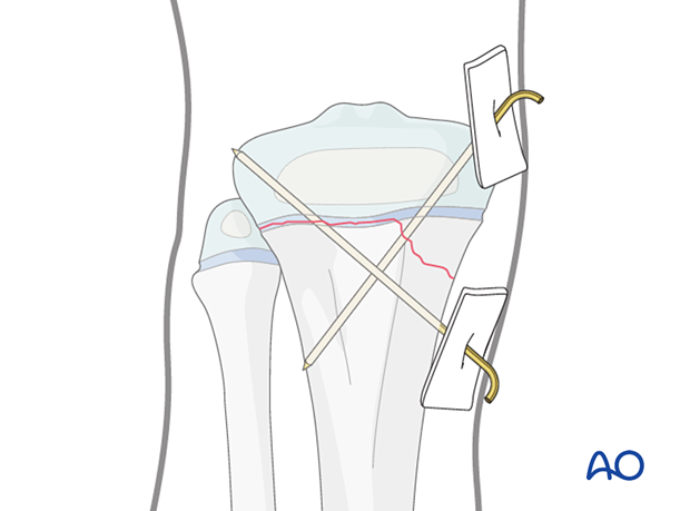 K-wire-wire fixation of a Salter-Harris type-II fracture of the proximal tibia