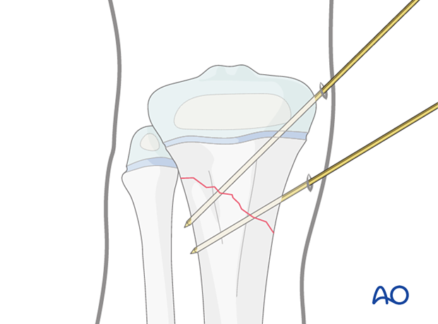 Insertion of second K-wire for fixation of a metaphyseal fracture of the proximal tibia