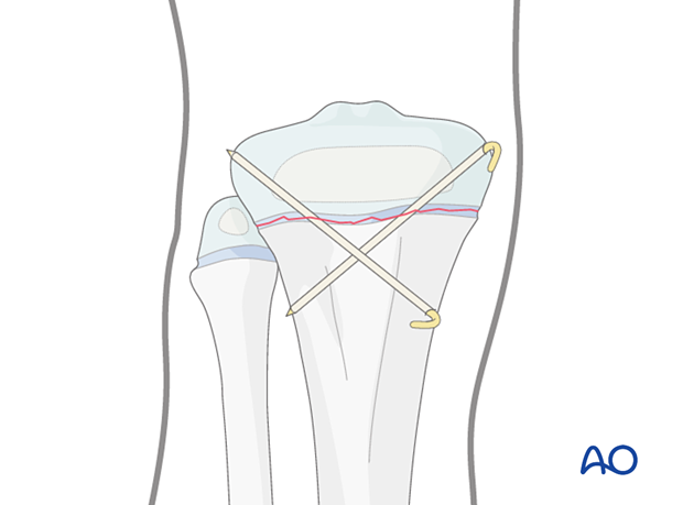 K-wire-wire fixation of a Salter-Harris type-I fracture of the proximal tibia