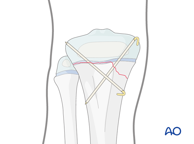 K-wire-wire fixation of a Salter-Harris type-II fracture of the proximal tibia