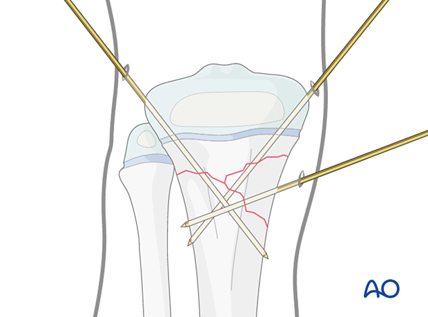 Insertion of K-wires for fixation of a multifragmentary metaphyseal fracture of the proximal tibia