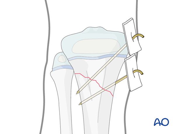 K-wire fixation of a metaphyseal fracture of the proximal tibia