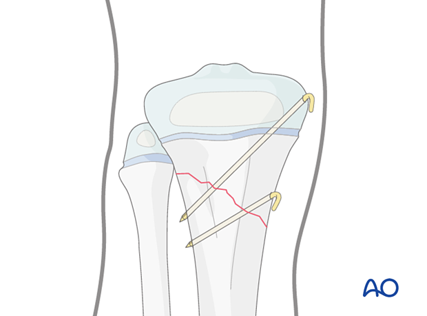 K-wire fixation of a metaphyseal fracture of the proximal tibia