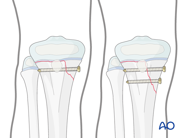 Screw fixation of a Salter-Harris type-II fracture of the proximal tibia