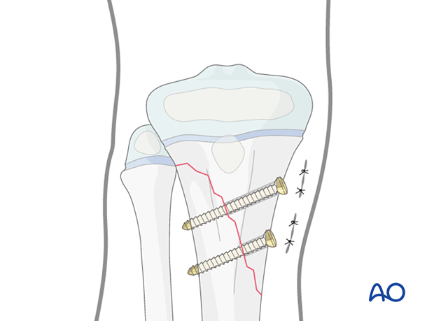 Screw fixation of a metaphyseal fracture of the proximal tibia