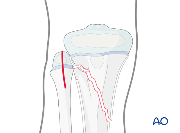 Incision for open reduction of entrapped periosteum in a metaphyseal fracture of the proximal tibia