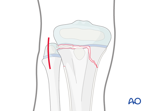 Open reduction - Screw fixation for Epiphysiolysis with metaphyseal ...