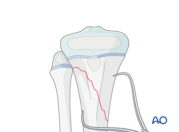 Direct reduction of a metaphyseal fracture of the proximal tibia